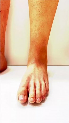 Enhancing Mobility and Confidence: Exploring Realistic Prosthetic Legs for Amputees