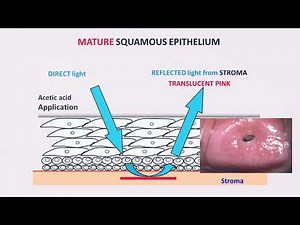 Colposcopy – Technique and Interpretation by Dr. Usha Saraiya