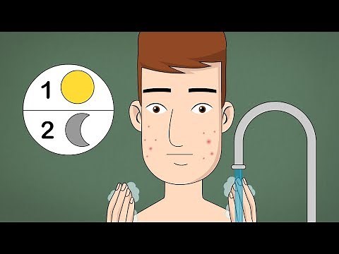 How to Treat Acne (Teen Boys)