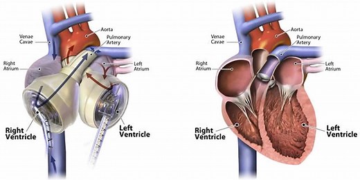 Artificial heart, total artificial heart, complications & life expectancy
